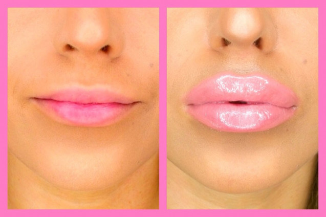 Lipgloss